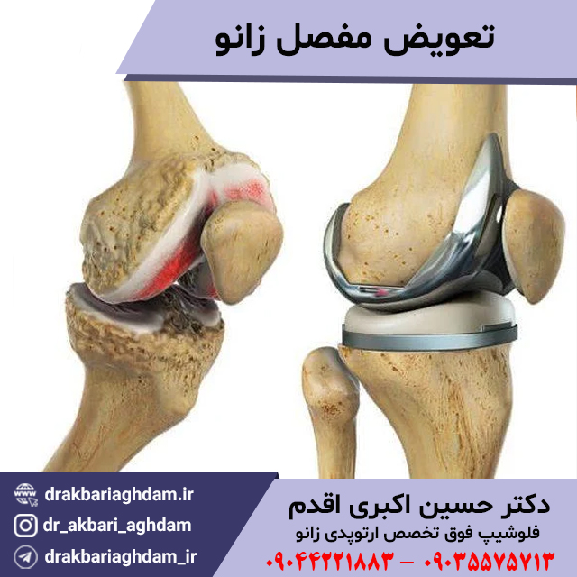 تعویض-مفصل-آرتروپلاستی