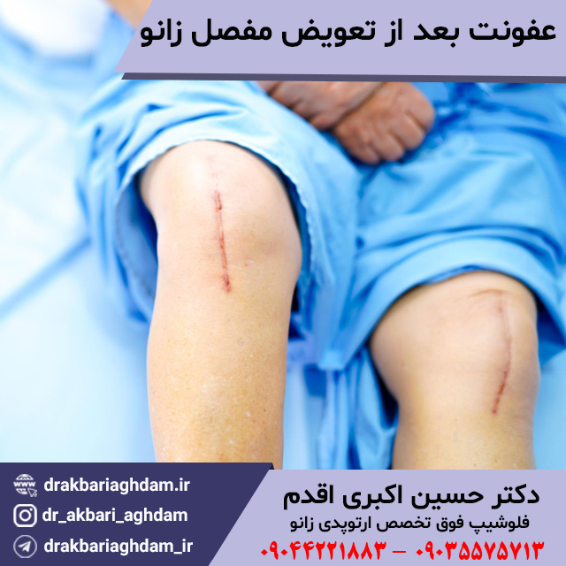 عفونت-بعد-از-تعویض-مفصل-زانو