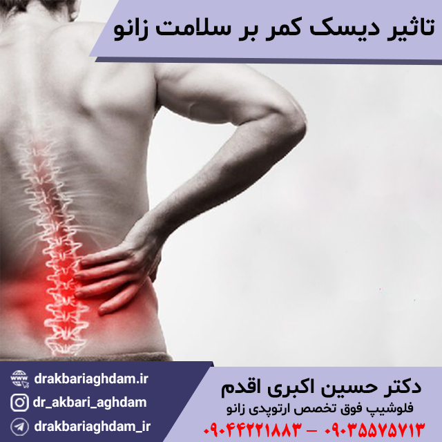 تاثیر-دیسک-کمر-بر-سلامت-زانو