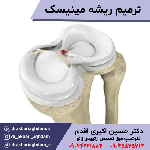 ترمیم-ریشه-مینیسک-زانو