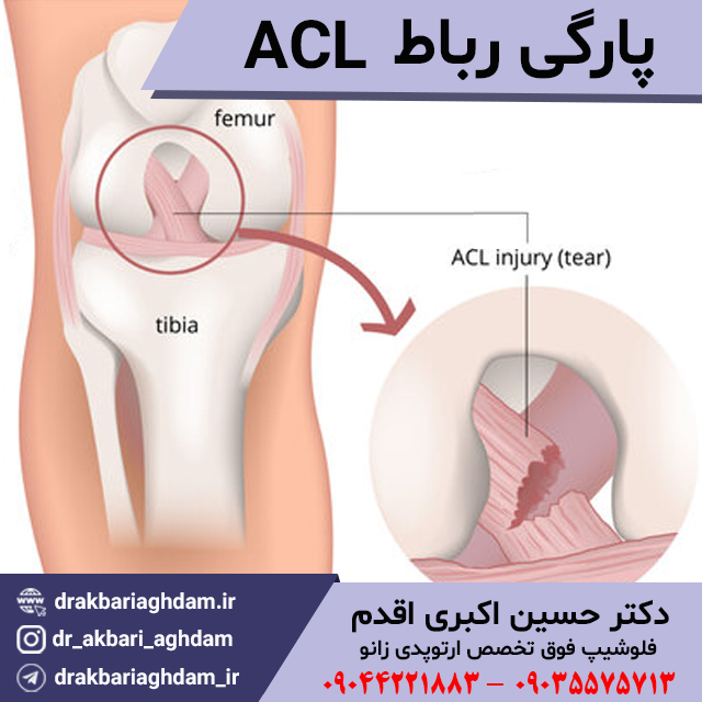 رباط-ACL