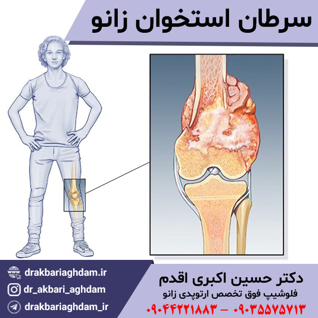سرطان-استخوان-زانو