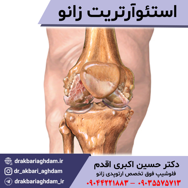 درمان-استئوآرتریت-و-ساییدگی-مفصل-زانو