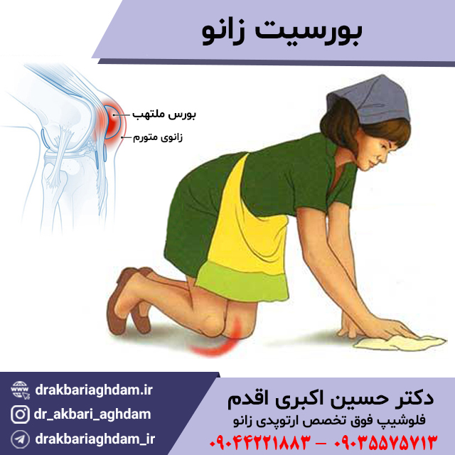 بورسیت-ملتهب-زانو