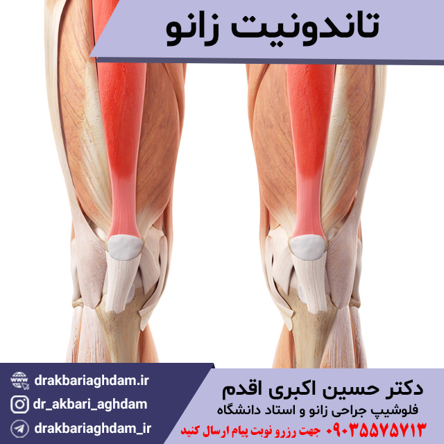 تاندونیت-زانو