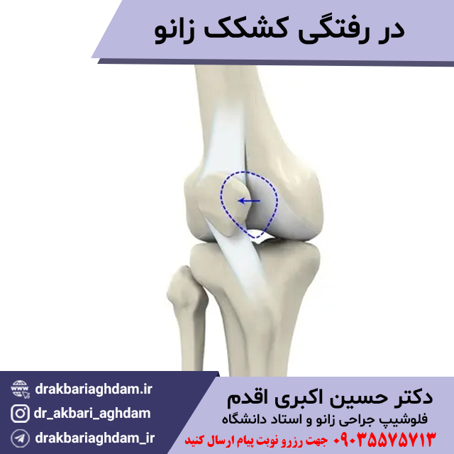 در-رفتگی-کشکک-زانو