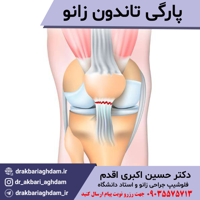 پارگی-تاندون-زانو