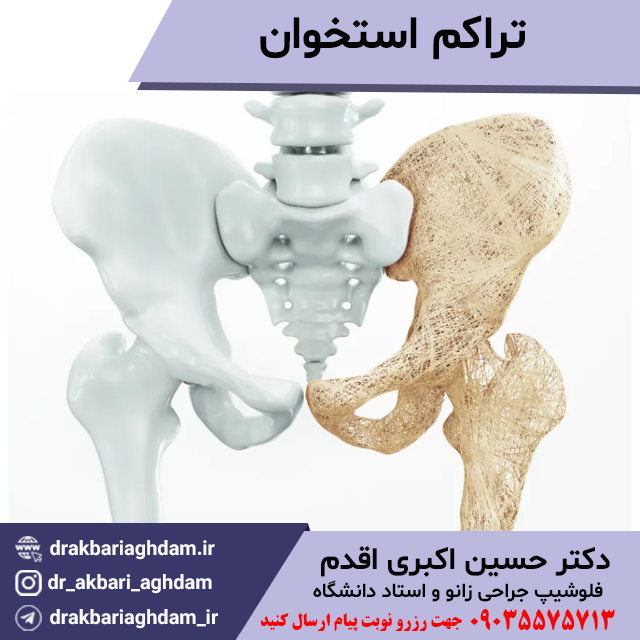 تراکم-استخوان-پوستر